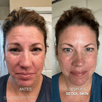 Kit de Microinfusión Facial