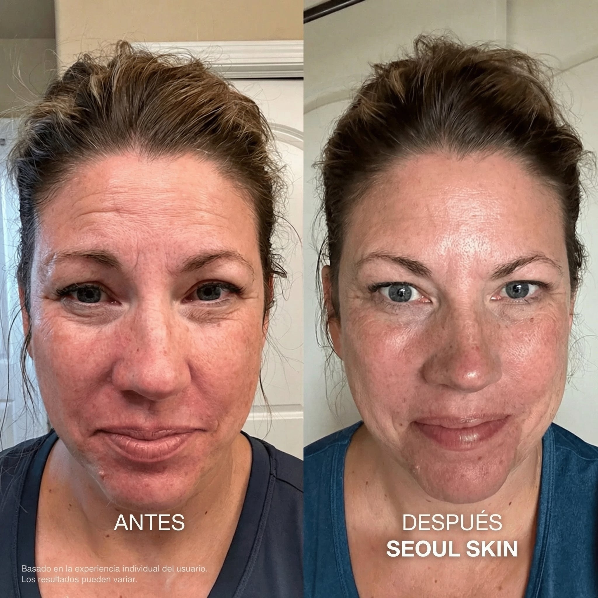 Kit de Microinfusión Facial