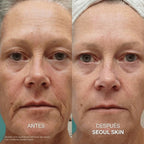 Kit de Microinfusión Facial