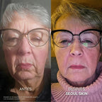 Kit de Microinfusión Facial